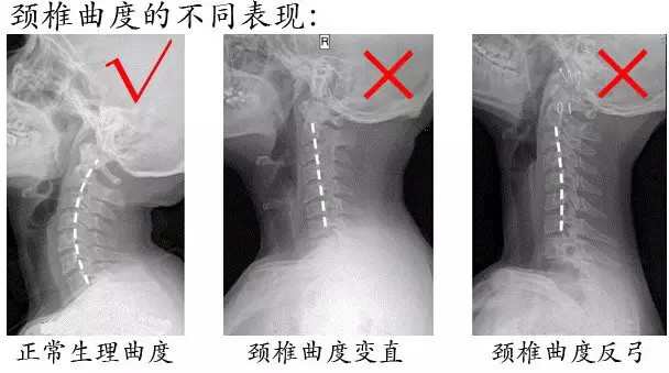 颈椎的生理弧度表现为向前凸出,能增加颈椎的弹性,减轻和缓冲重力的