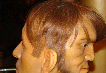 恐怖!世界上真的有"双面人"